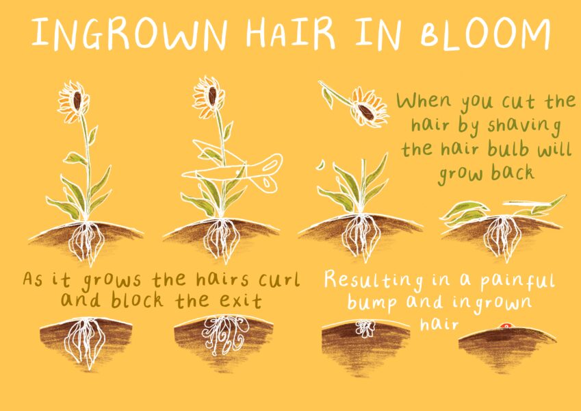 Ingrown hair in bloom